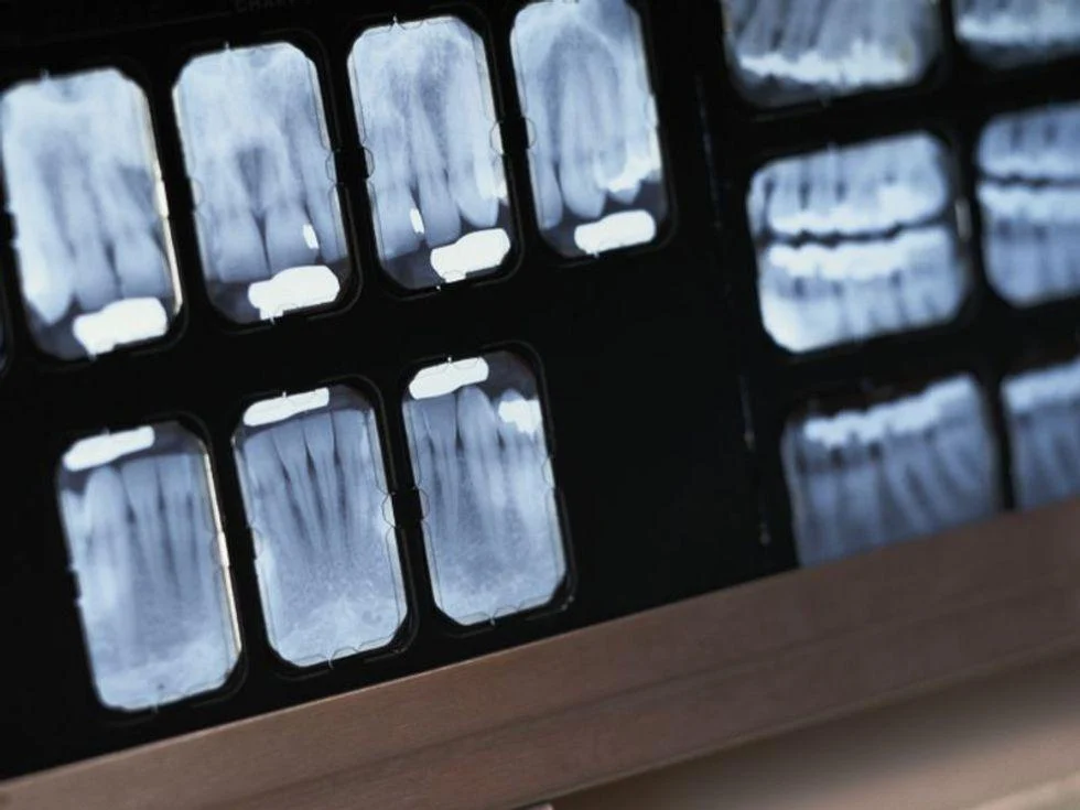 Image d'actualité : le groupe dentaire dit que les tabliers en plomb ne sont plus nécessaires pour les radiographies