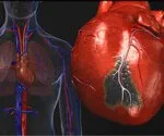 Maladie cardiaque : Causes d'une crise cardiaque