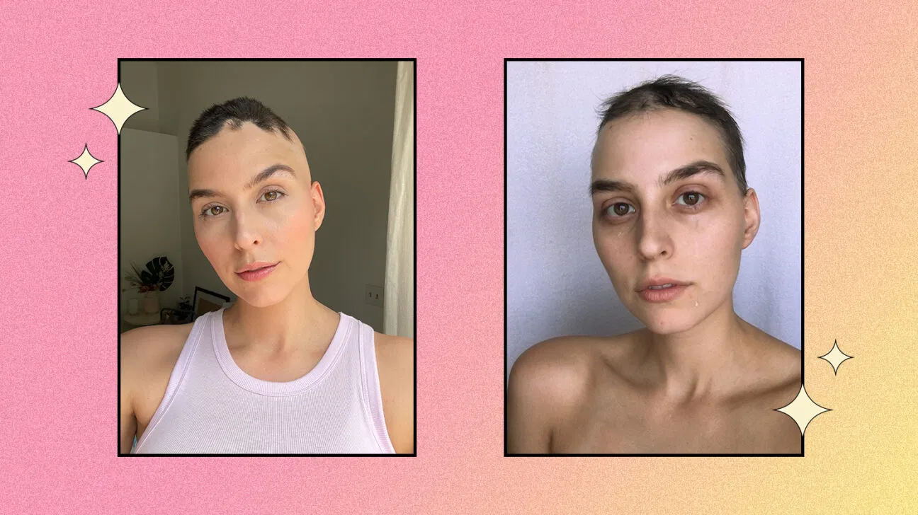 Due foto di Robyn Germyn, un'influencer sociale che vive con l'alopecia areata; una foto la mostra mentre piange mentre nell'altra sorride