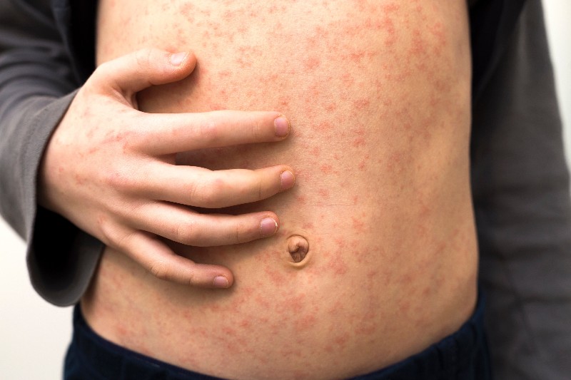 News Picture: What Is Measles, and How Can I Shield Myself & My Family?