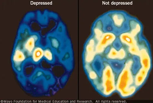 SLIDESHOW: Learn to Spot Depression: Symptoms, Warning Signs, Medication