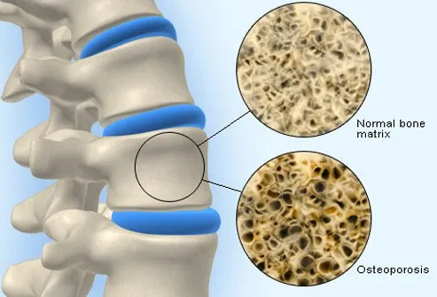 DIAPORAMA : Qu'est-ce que l'ostéoporose? Traitement, symptômes, médicaments