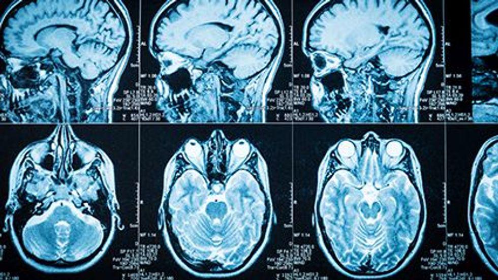 Photo d'actualité : Le fer s'accumule dans le cerveau après les commotions cérébrales