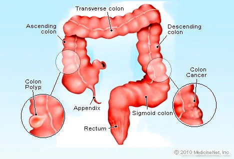 Ilustração de câncer de cólon